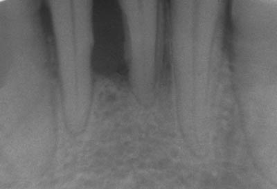 Xray showing Periodontal Damage