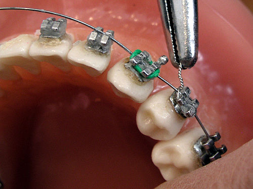 Brackets for Orthodontics