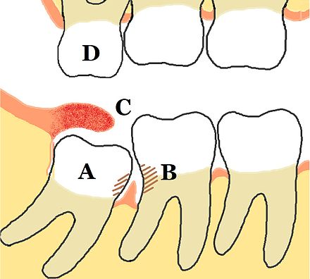 An Image showing potential Wisdom Teeth Issues