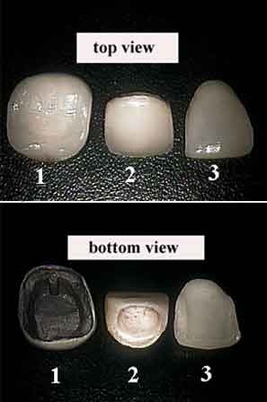 Comparison between a porcelain-metal dental crown